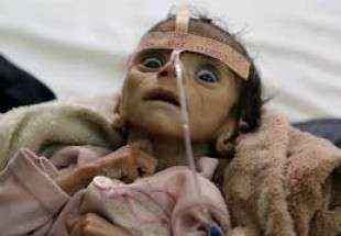 Growing number of Yemeni defected newborns