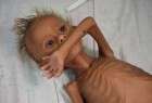 Malnourished Yemeni kids struggling with death (photo)  <img src="/images/picture_icon.png" width="13" height="13" border="0" align="top">