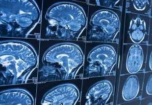 ما علاقة هيكل الدماغ بمعدل الذكاء؟