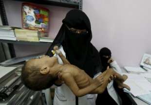 یک ‌میلیون و ۸۰۰ هزار کودک یمنی از سوء‌تغذیه شدید رنج می‌برند