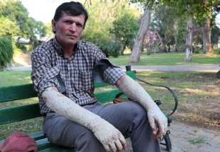 The tale of a Turkish man living with snakelike skin