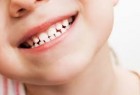 ​عوامل ابتلا به پوسیدگی دندان در کودکان چیست؟
