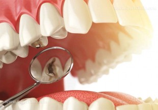 ​چرا دندان هایمان پوسیده می شوند؟