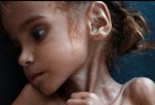 Amal Hussein, face of starving Yemen, dies at 7