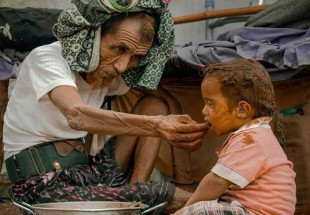 85 ألف طفل يمني قضوا بسبب سوء التغذية الحادّ