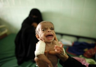 جان باختن ۸۵ هزار کودک در یمن به دلیل سوء تغذیه