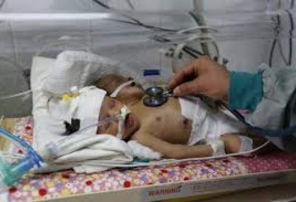 یمن پر سعودی جارحیت کے باعث دھڑ سے جڑے بچے علاج سے محروم