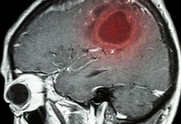 مصابون بسرطان الدماغ يكشفون أعراضا لم يعيروها سابقا أي أهمية