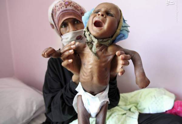 آمار بالای مرگ و میر کودکان یمنی به دلیل سوء تغذیه و بیماری های واگیردار