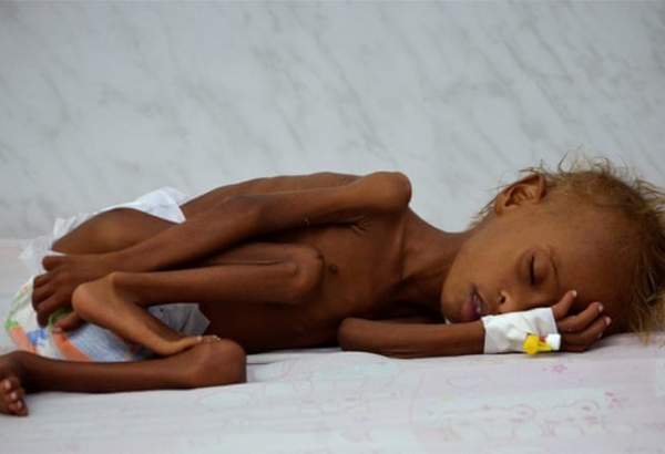 غذائی قلت اور وبائی امراض کی وجہ سے ہر پانچ منٹ میں ایک یمنی بچہ موت کا شکار ہوجاتا ہے۔