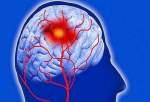 افزایش تری گلیسیریدها خطر سکته مغزی دوم را بالا‌ می‌‌برد