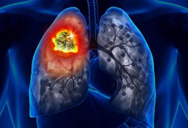 سرماخوردگی سخت و طولانی می‌تواند علامت ابتدایی سرطان ریه باشد