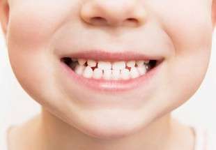 طريقة تحمي الأسنان اللبنية من التسوس
