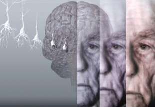 آلزایمر و ارتباط آن با بیماری‌های مزمن چشمی