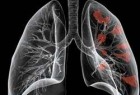 نشانه‌های عجیب سرطان ریه را بشناسید