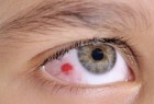 كيف يتم علاج العمى الثلجي الناتج عن حروق الشمس في العين