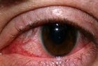 ​التهاب چشم را جدی بگیرید