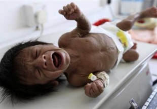 18 مليون يمنيّ مُعرّضون لـلمجاعة