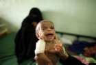 جان باختن ۸۵ هزار کودک در یمن به دلیل سوء تغذیه