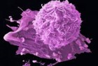 افزایش 4 برابری سرطان پروستات با بیماری التهابی روده