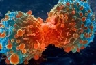 7 أعراض رئيسية للسرطان