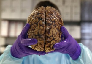 علماء روس يستخدمون فيروسا لقتل سرطان الدماغ
