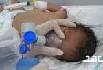 وزارة الصحة في صنعاء : وفاة 80 طفلا حديث الولادة يوميًا بفعل الحرب والحصار